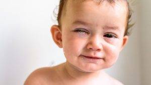 bebé con conjuntivitis