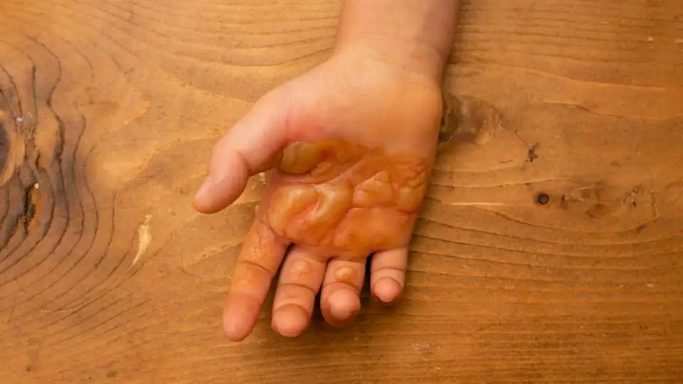 mano de niño con ampolla de quemadura